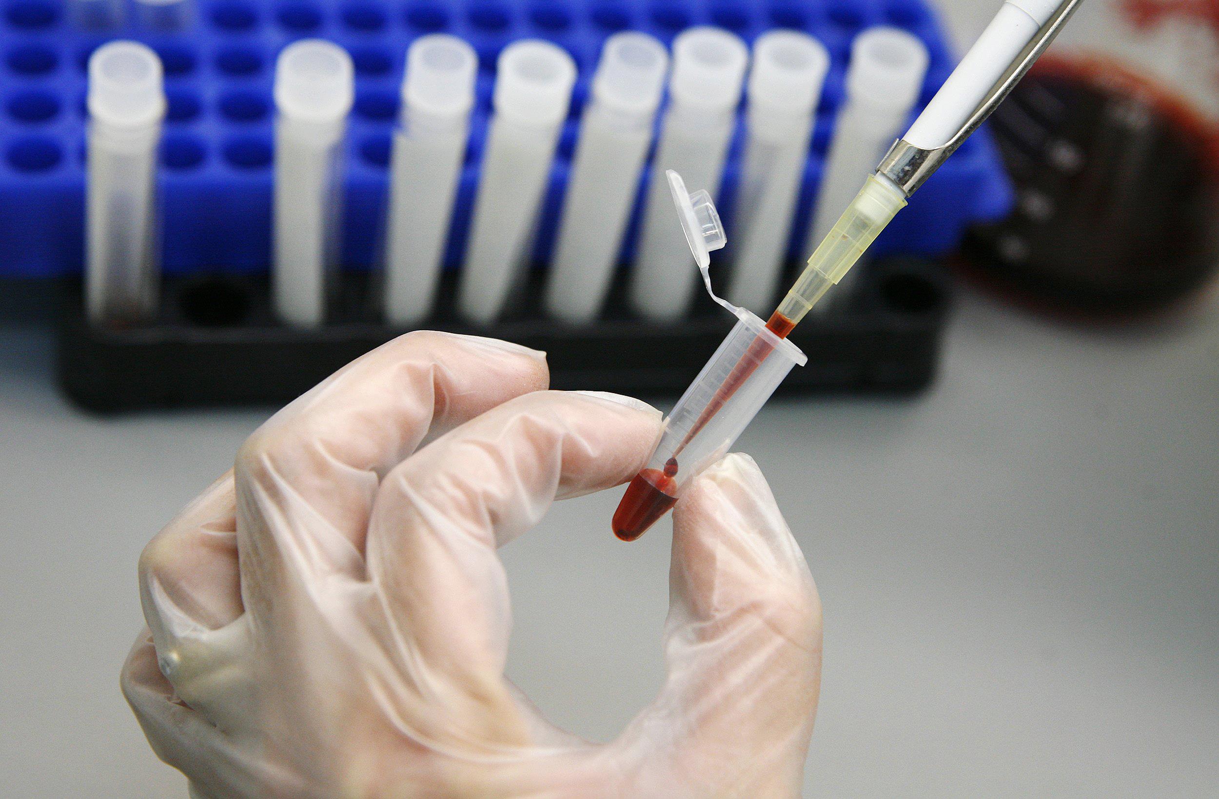 Анализ крови на ВИЧ в Новосибирске по низким ценам